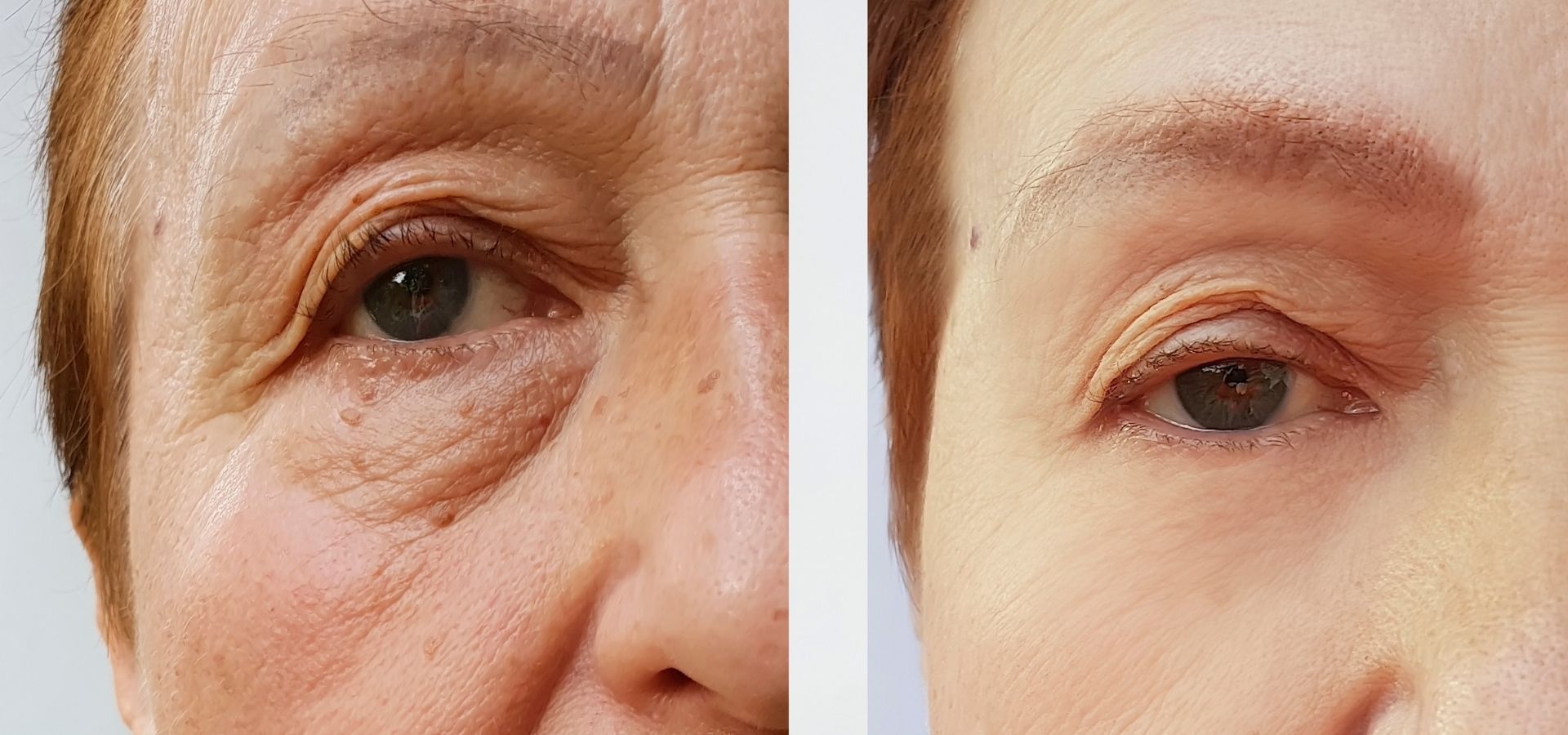 Kırışıklık Karşıtı Masaj Teknikleri