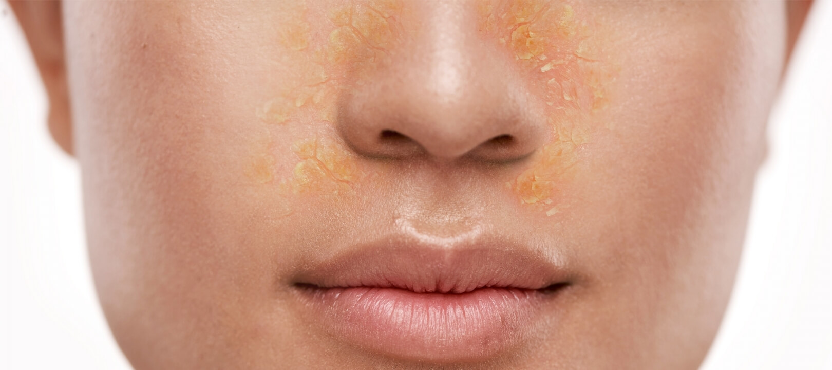 Seboreik Dermatit ile Baş Etmenin Doğal Yolları