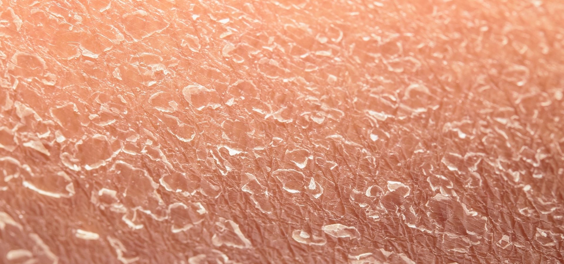 Cilt Kuruluğu Problemi İçin Beslenme Önerileri