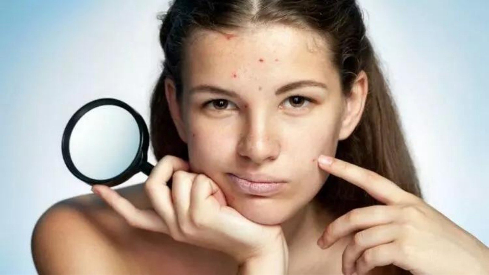 Ergenlik sivilceleri