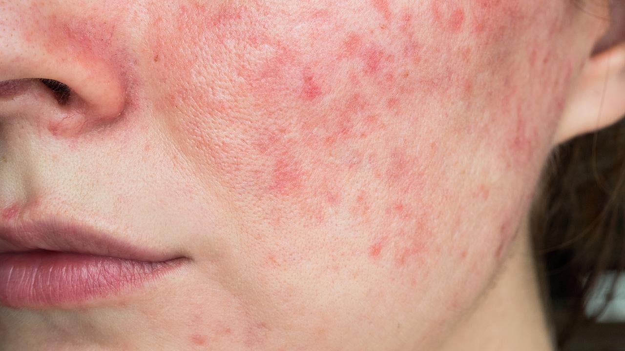 Egzama için yaz aylarında cilt bakımı