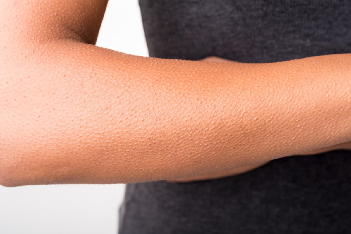 Keratosis Pilaris İçin Yumuşatıcı Ürünler