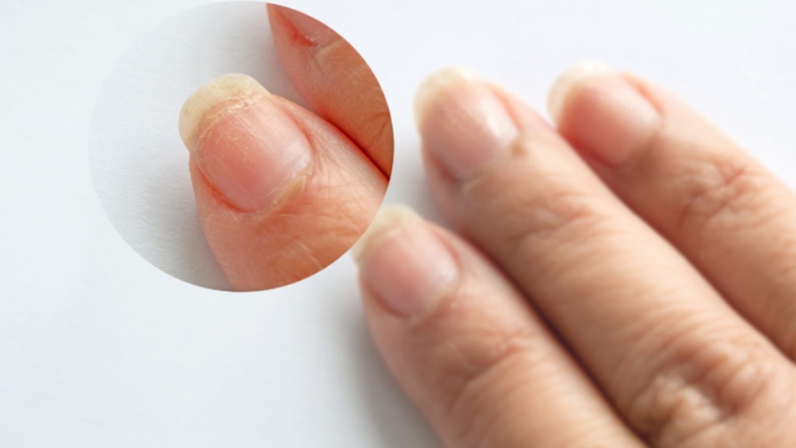 tırnak kırılması