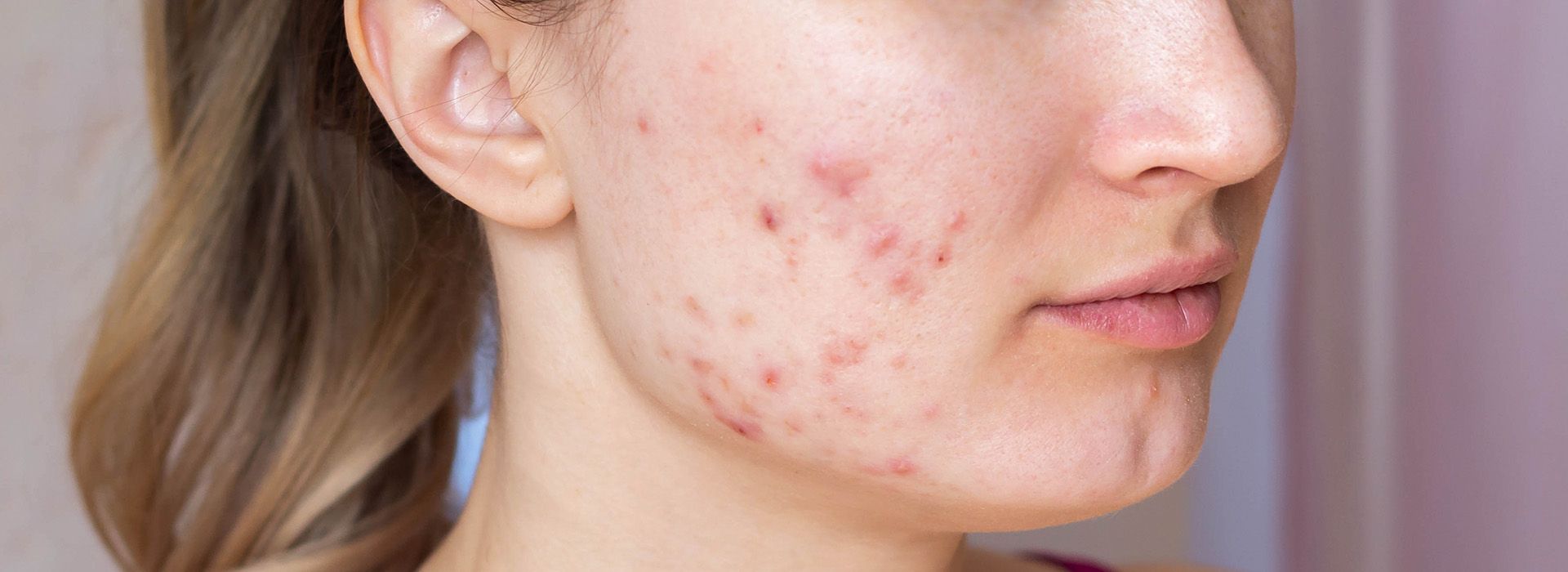 Akne Oluşumunun Nedenleri