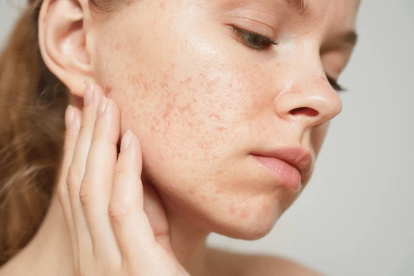 Close Up Women Touching Her Acne on Her Face