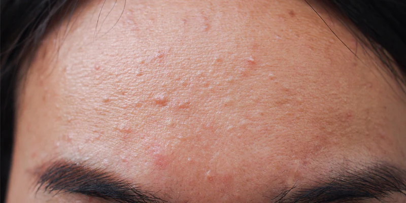 Fungal Acne