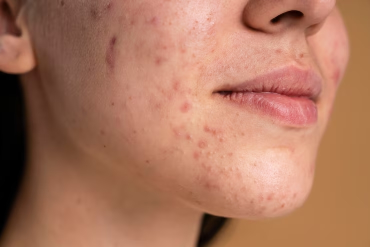 woman with acne scars